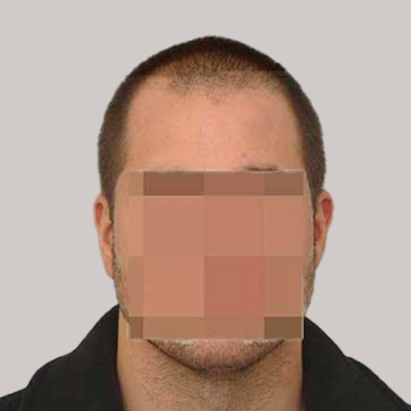 Hair Transplant 2202 grafts FUE