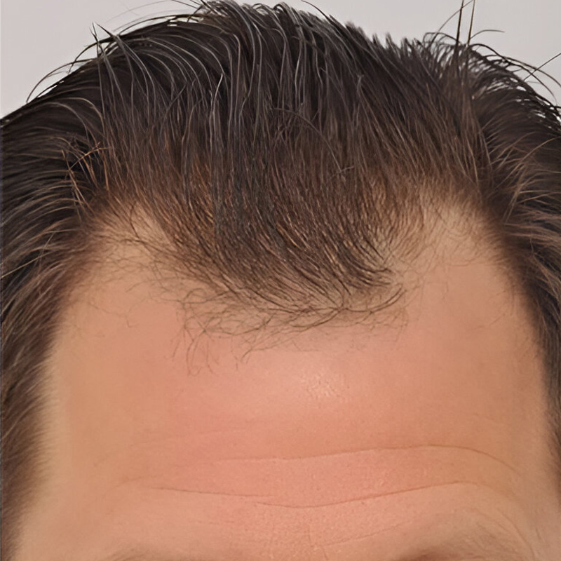 Hair Transplant 2201 grafts FUE
