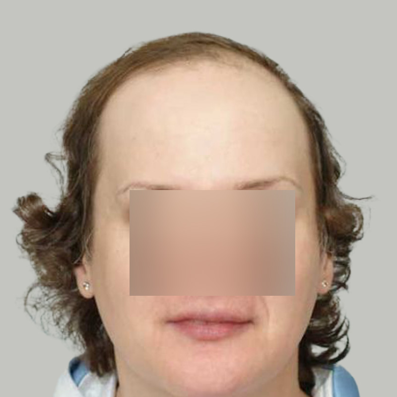 Hair Transplant 3200 grafts FUE