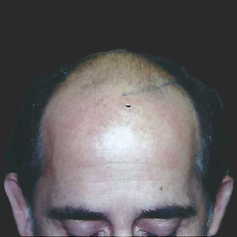 Hair transplant 7000 grafts FUE featured