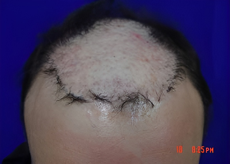 Scalp Repair 3951 grafts FUE
