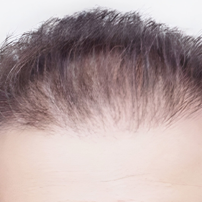 Hair Transplant 2700 grafts FUE