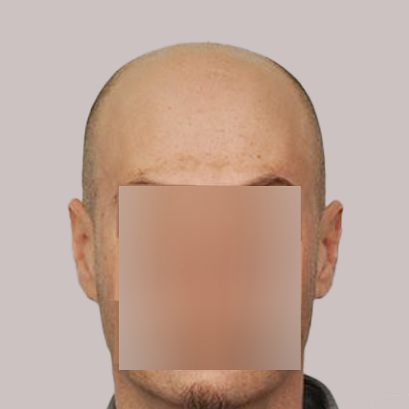 Hair Transplant 3605 grafts FUE
