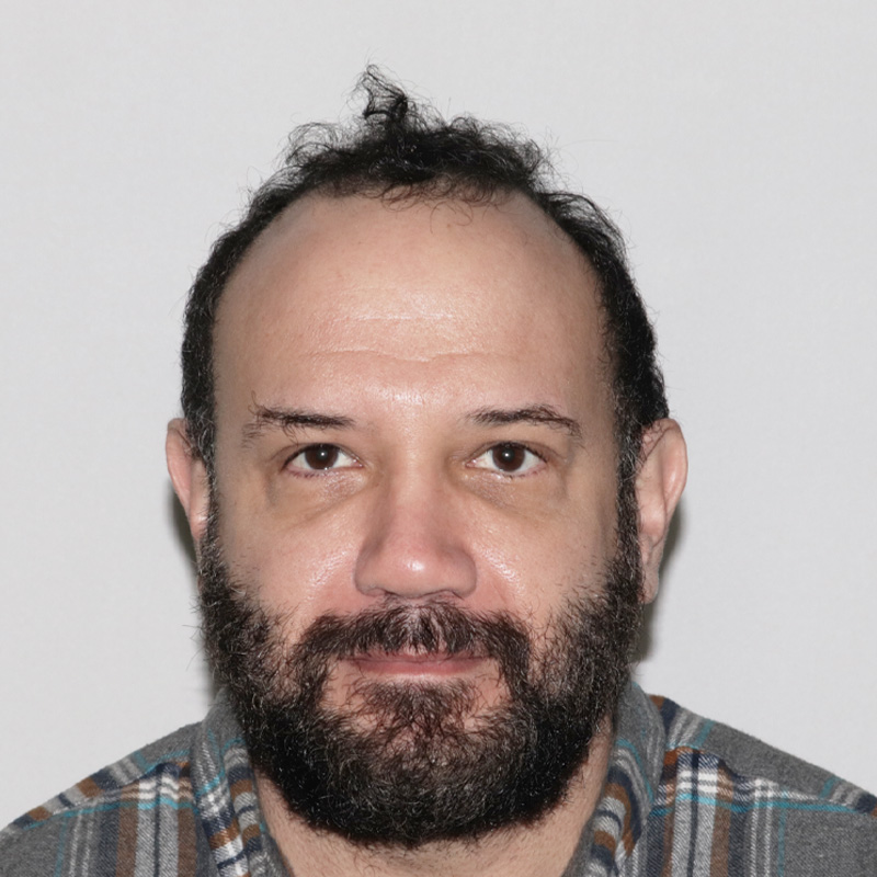 Hair Transplant 4200 grafts FUE