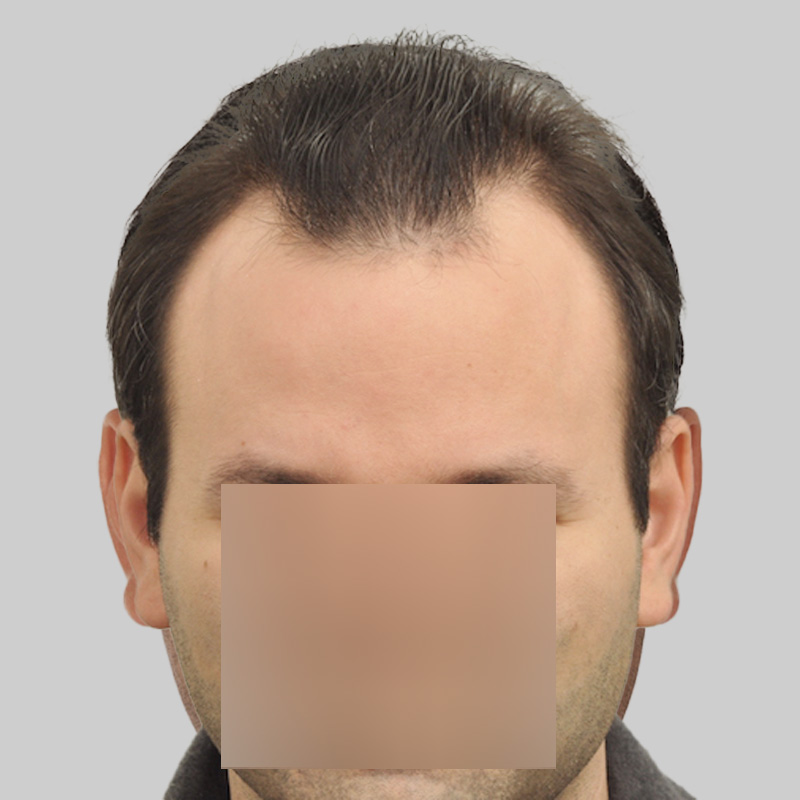 Hair Transplant 2004 grafts FUE
