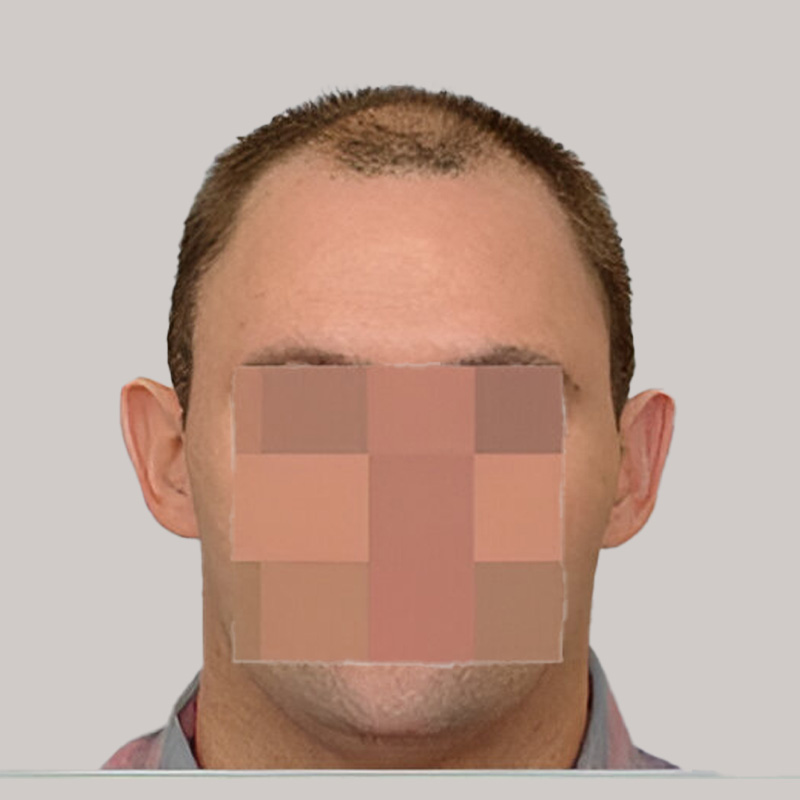 Patient UJT before & after FUE results comparison front