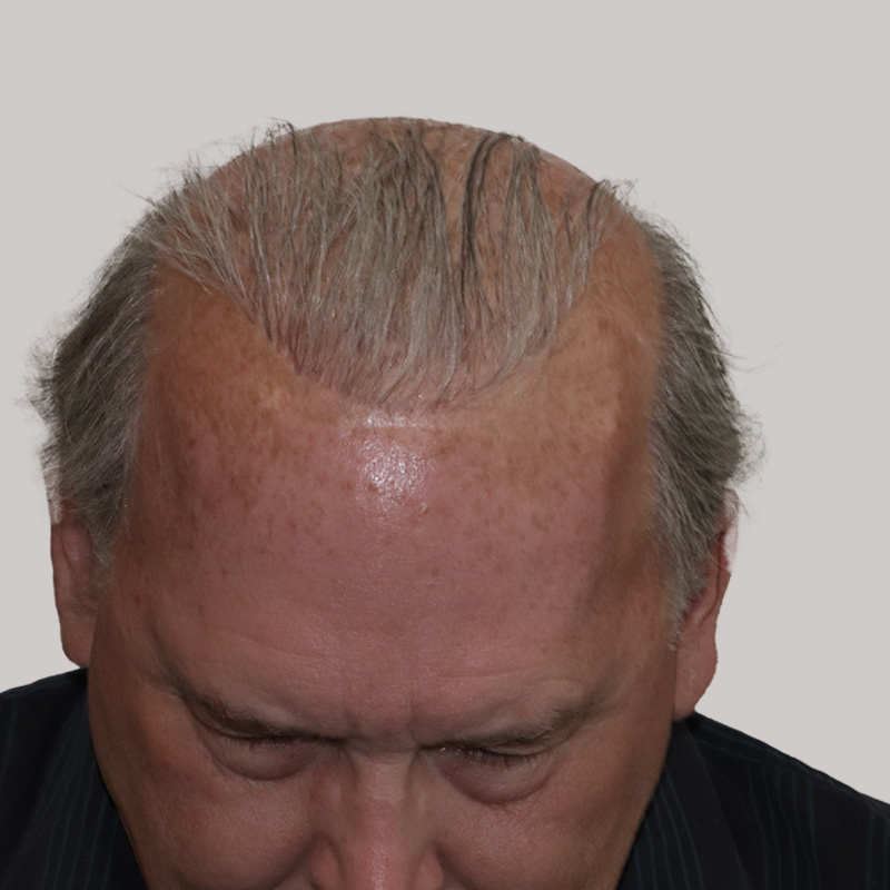 Hair Transplant 3000 grafts FUE