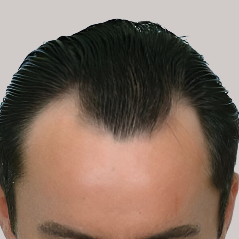 Hair Transplant 2055 grafts FUE