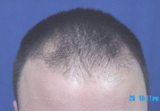 Hair Transplant 1101 grafts FUE