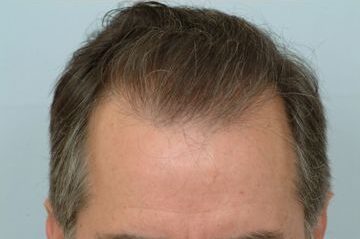 Hair Transplant 1400 grafts FUE