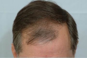 Hair Transplant 1400 grafts FUE