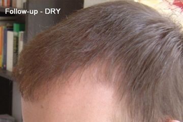 Hair Transplant 1701 grafts FUE