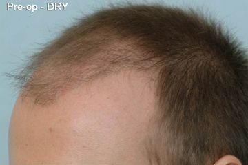 Hair Transplant 1701 grafts FUE