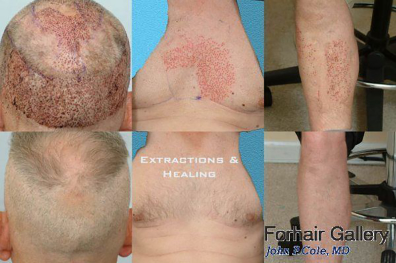 Hair Transplant 6102 grafts FUE body hair extractions