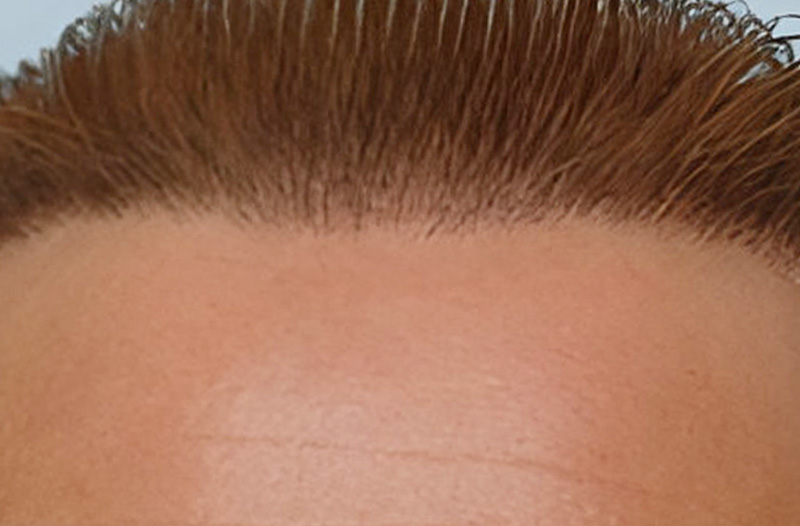 Hair Plug Redistribution 541 grafts