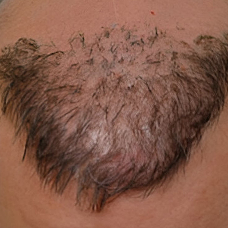 Hair Plug Removal