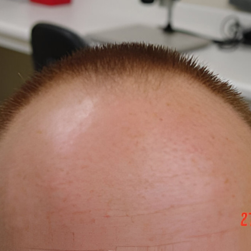 Hair Transplant 2040 grafts FUE