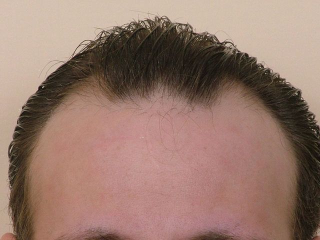 Hair Transplant 4800 grafts FUE