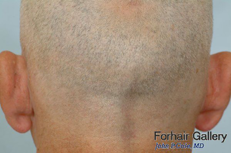 Hair Transplant 6102 grafts FUE donor healing