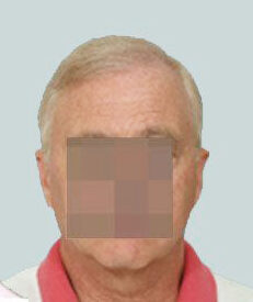 Hair Transplant 2000 grafts FUE