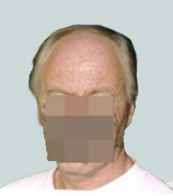 Hair Transplant 2000 grafts FUE