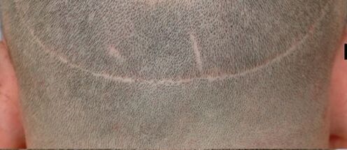 Scar Repair 301 grafts FUE