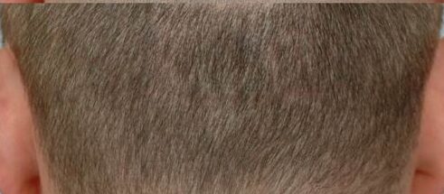 Scar Repair 301 grafts FUE