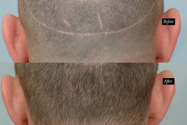 Scar Repair 301 grafts FUE