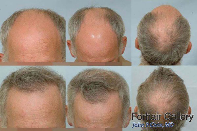 Hair Transplant 6102 grafts FUE collage #2
