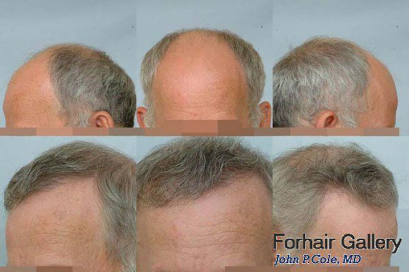 Hair Transplant 6102 grafts FUE collage #1