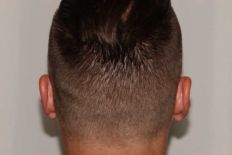 Donor area after FUE