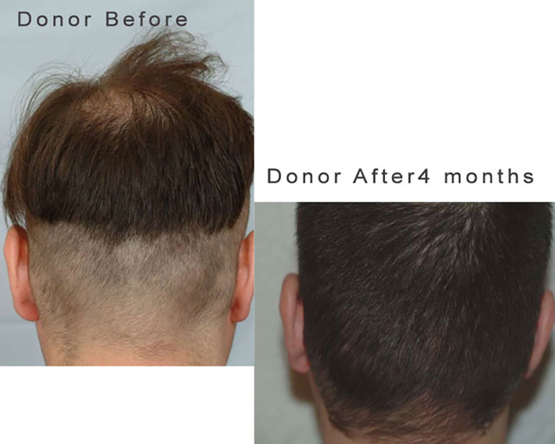 Donor Area healing