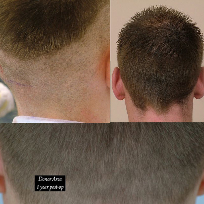 Donor area after shaved