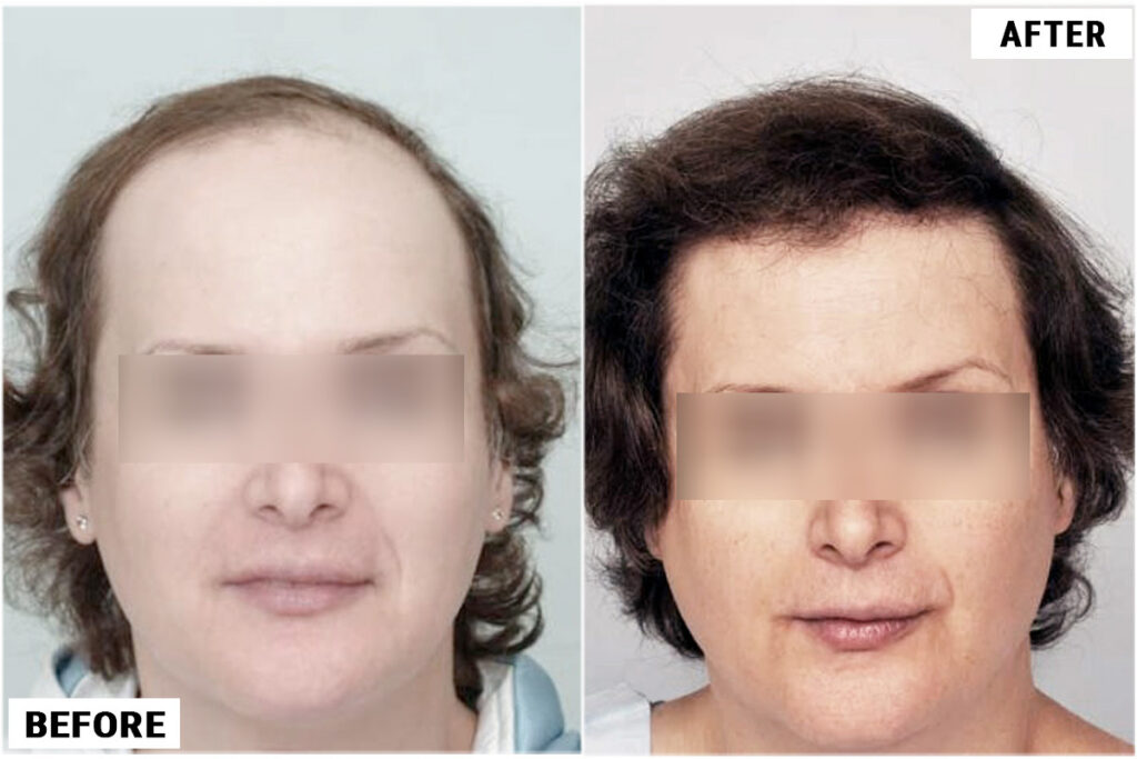 Hair Transplant 3200 grafts FUE