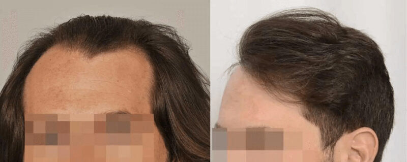 Hair Transplant 2234 grafts FUE before after left side