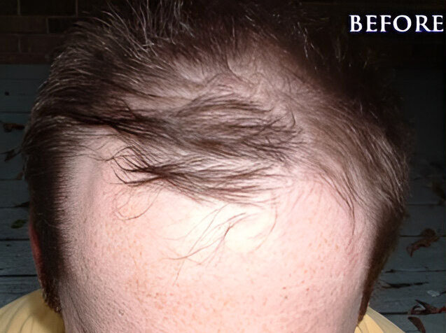 Hair Transplant 1040 grafts FUE