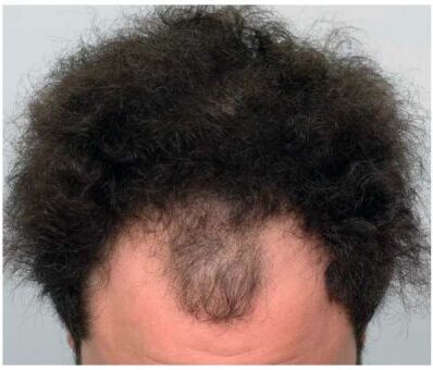 Hair Transplant 2373 grafts FUE