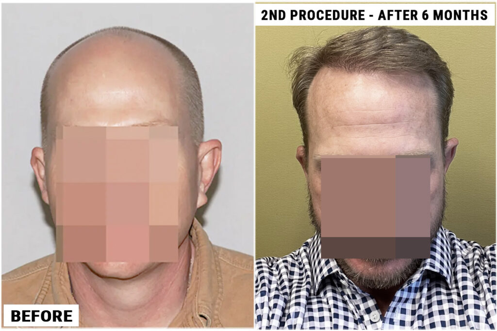 2nd FUE procedure front view