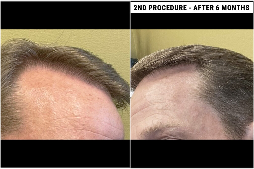 2nd FUE procedure side view