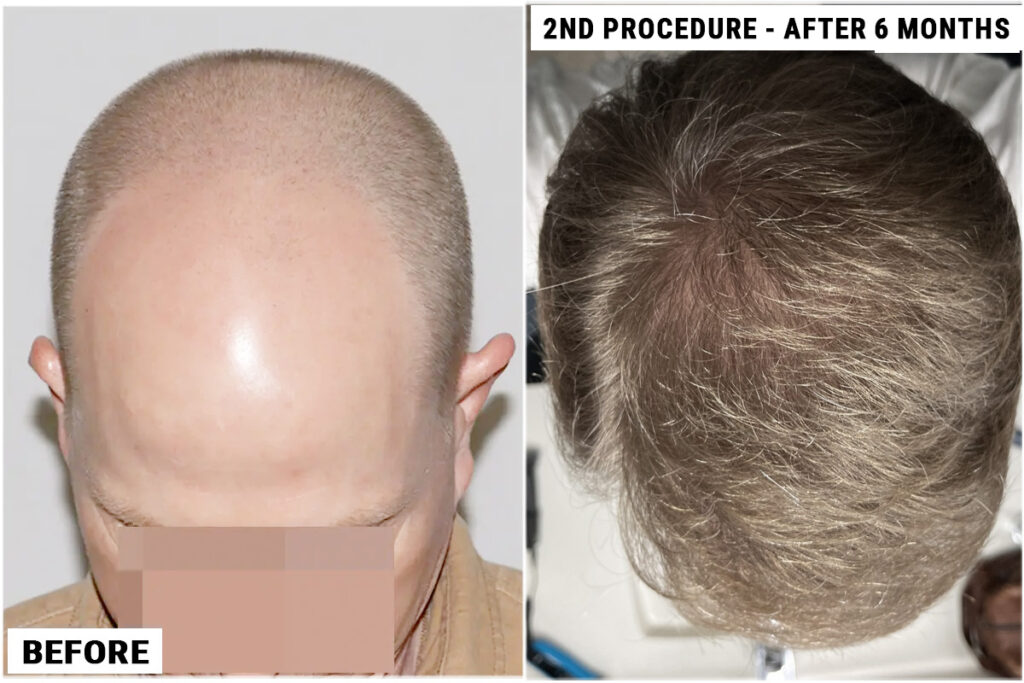 2nd FUE procedure top view