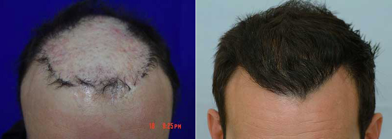 Scalp Repair 3951 grafts FUE front
