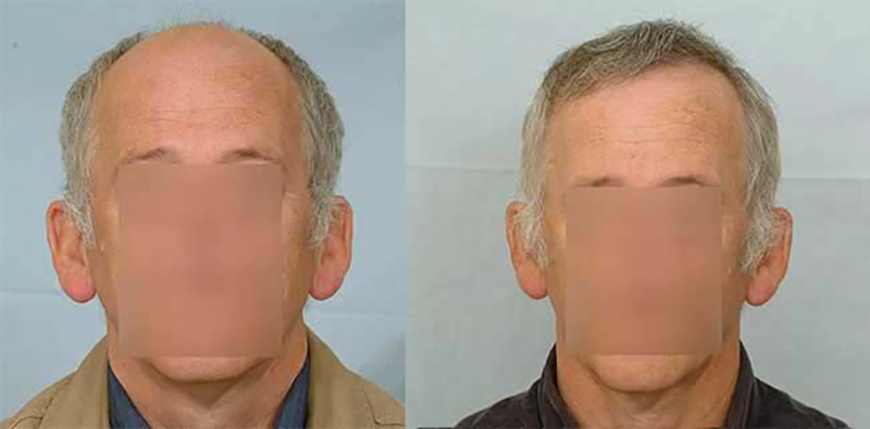 Hair Transplant 6102 grafts FUE Front