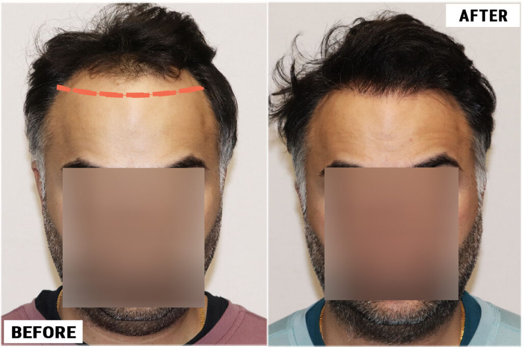 Hairline comparison