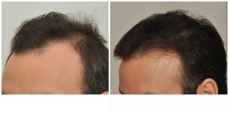 before and after right