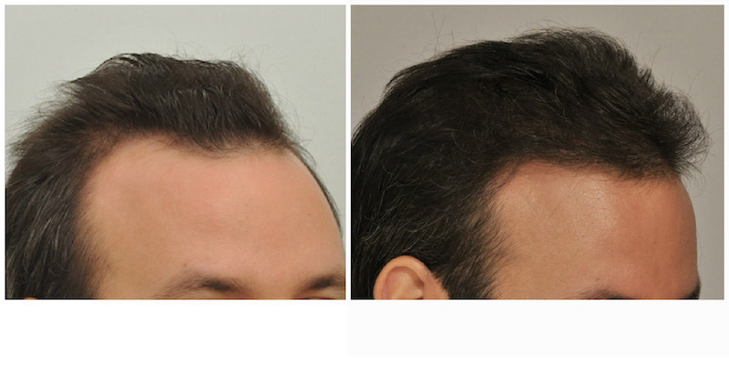 before and after left view