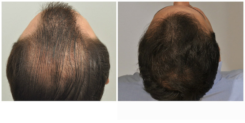 before and after crown