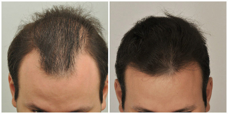 before and after top 2
