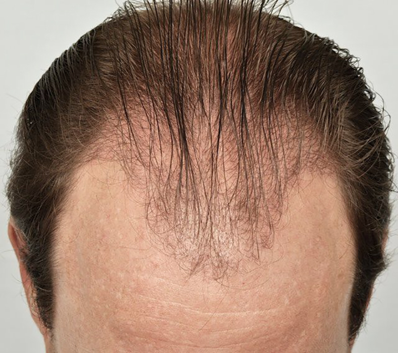 Hair Transplant 4698 grafts FUE