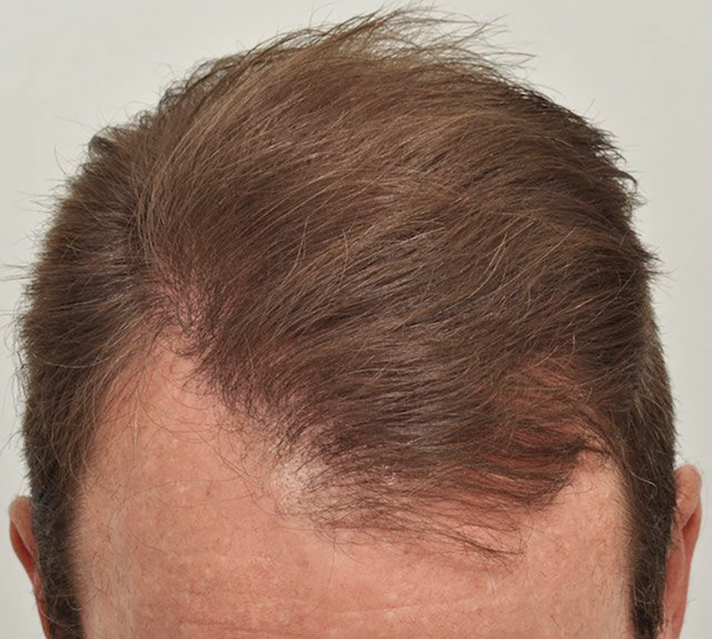 Hair Transplant 4698 grafts FUE