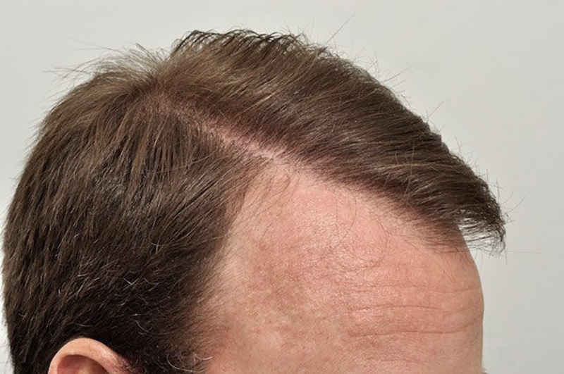 After results right hairline